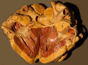 Heart of a cow (Bos taurus L.). Tubercolosis of pericardium and heart