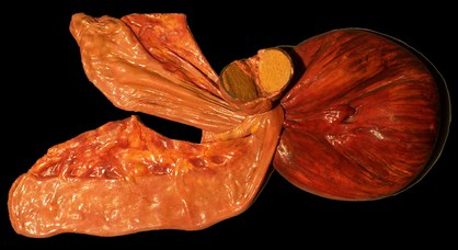 Intestine of a horse (Equus caballus L.). Torsion