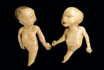 Anatomical model representing two fetuses suffering from sirenomelia - Wax modeller: Giuseppe Astorri
