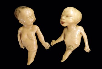 Modello anatomico rappresentante due feti affetti da sirenomelia - Ceroplasta Giuseppe Astorri