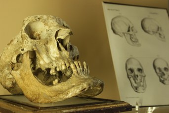 Cranio di soggetto Acromegalico - Ceroplasta Pietro Sandri