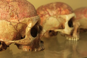 Diploe delle ossa del cranio: calotta cranica privata del tavolato osseo